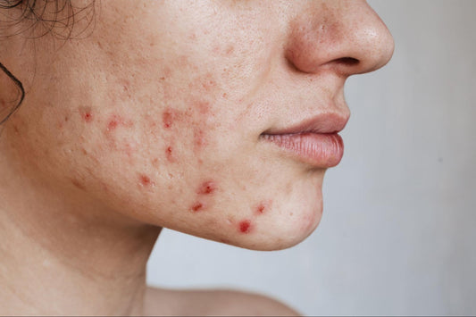 Is Your Protein Powder Causing Breakouts? The Hidden Link Between Dairy and Acne